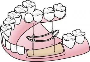 Screwless implant diagram — metal framework on jawbone and fixed bridge placement