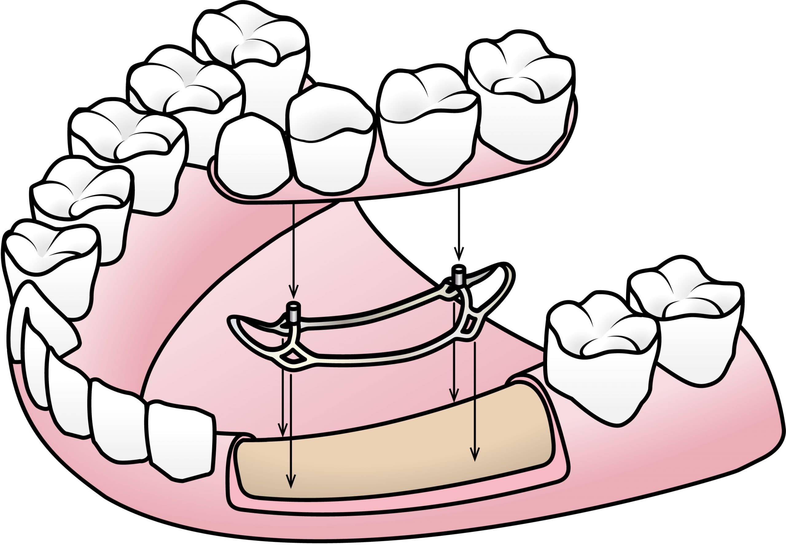 Screwless Dental Implants
