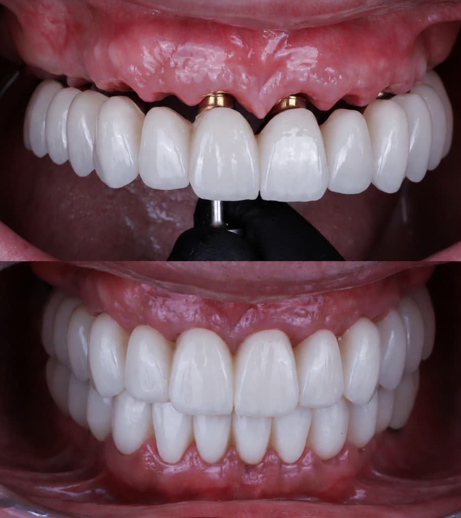 Dental implant transformation