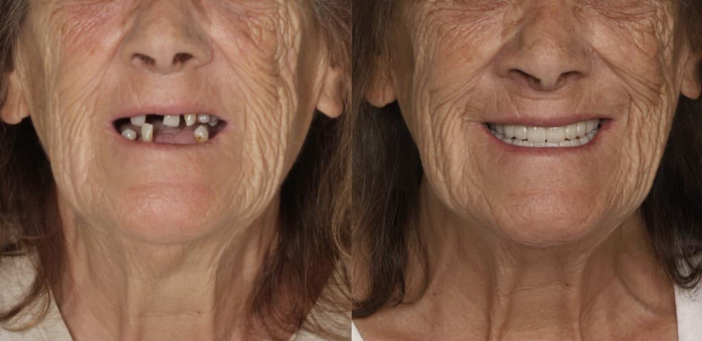 Dental implants before and after — full smile rehabilitation