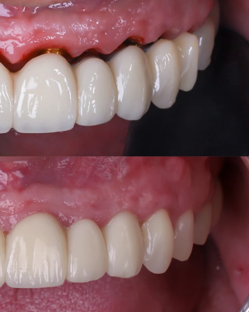 Dental implants before and after