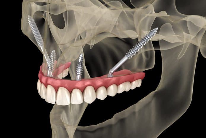 Comparison of pterygoid, zygomatic, and conventional implants