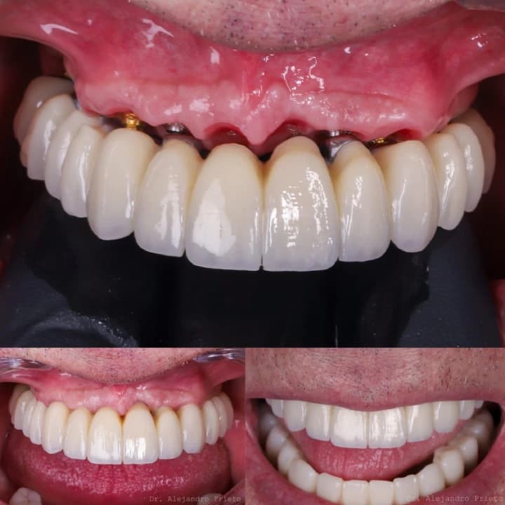 What are immediate loading dental implants