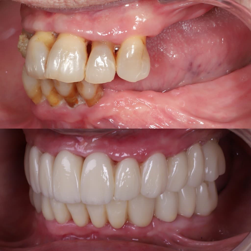 Dental implant treatment — before and after full-mouth rehabilitation