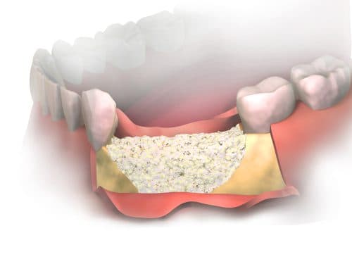 Dental Bone Graft in Madrid