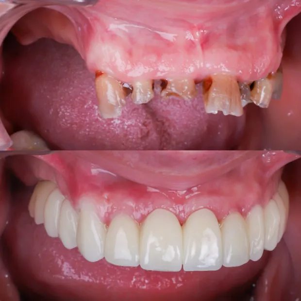 Fixed denture on implants testimonial
