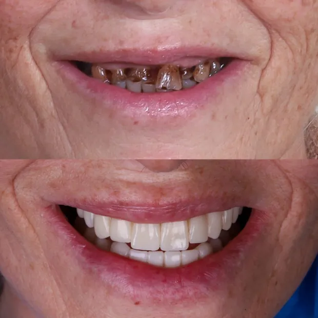 Fixed denture on implants result