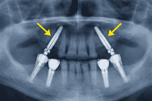 Transnasal implants — radiographic example of implant anchorage