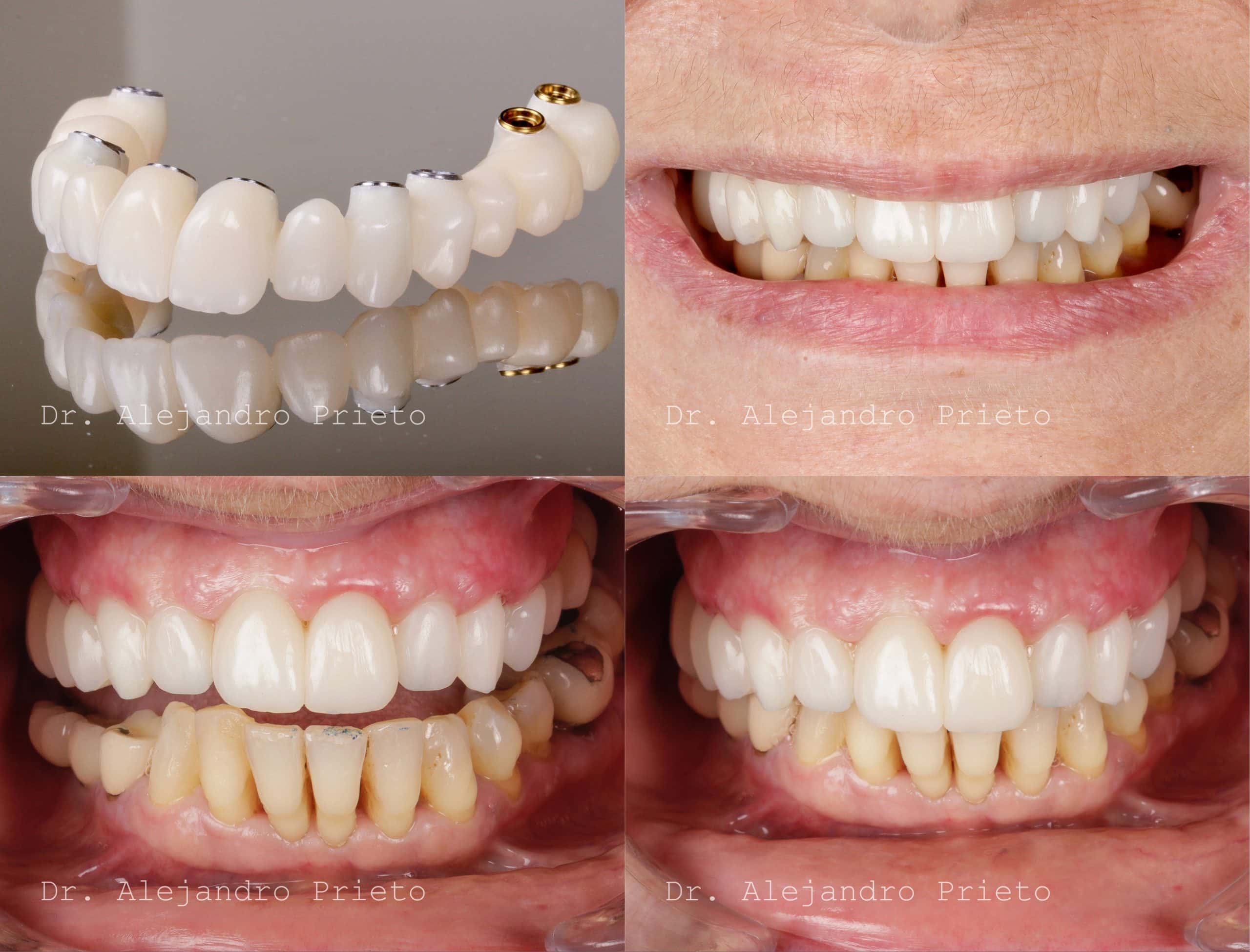 Dental implant smile restoration