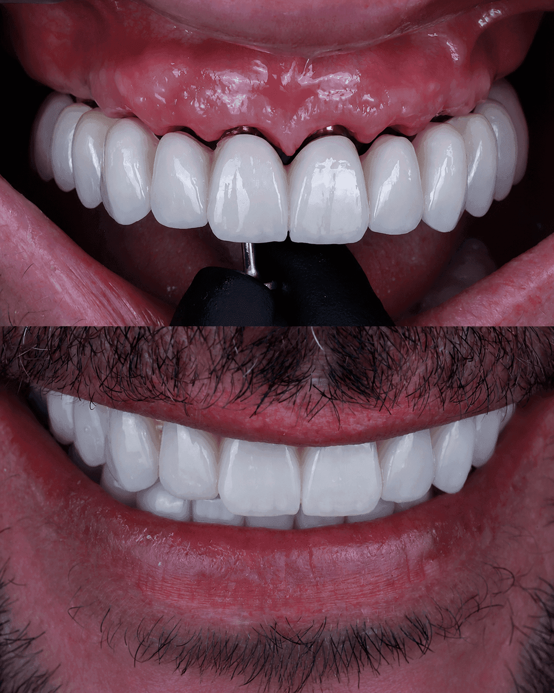 All-on-4 implant case