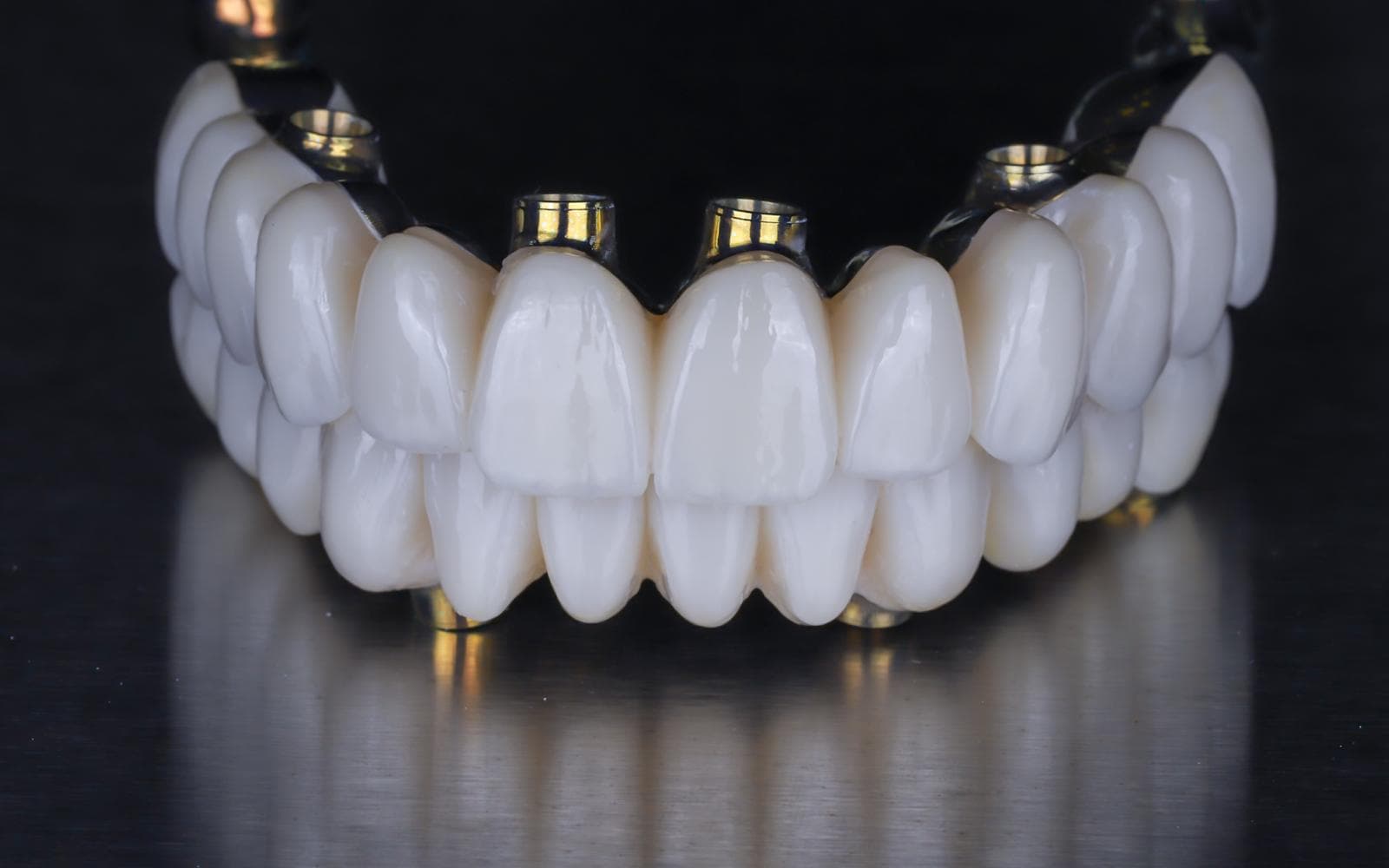 Full-Mouth Dental Implants in One Day