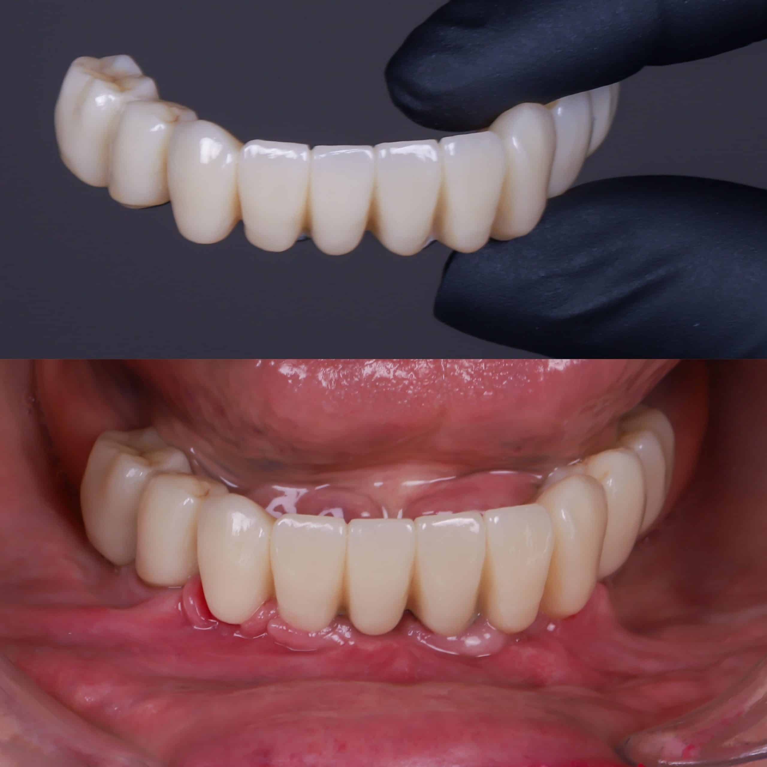 Fixed prosthesis on implants