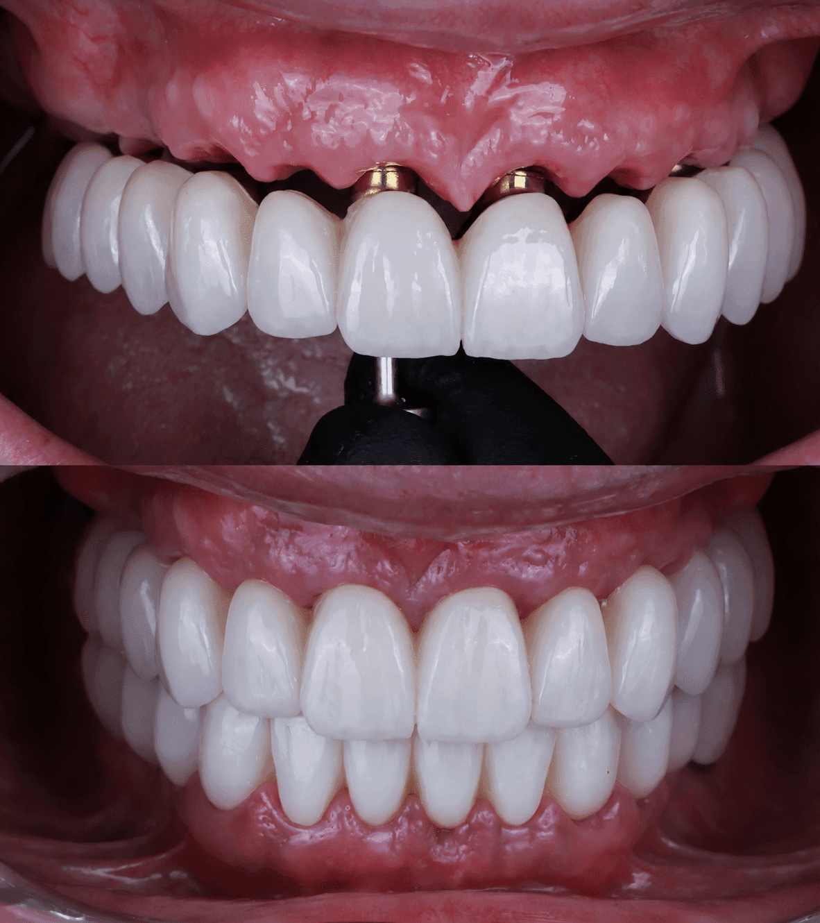 Porcelain veneers makeover