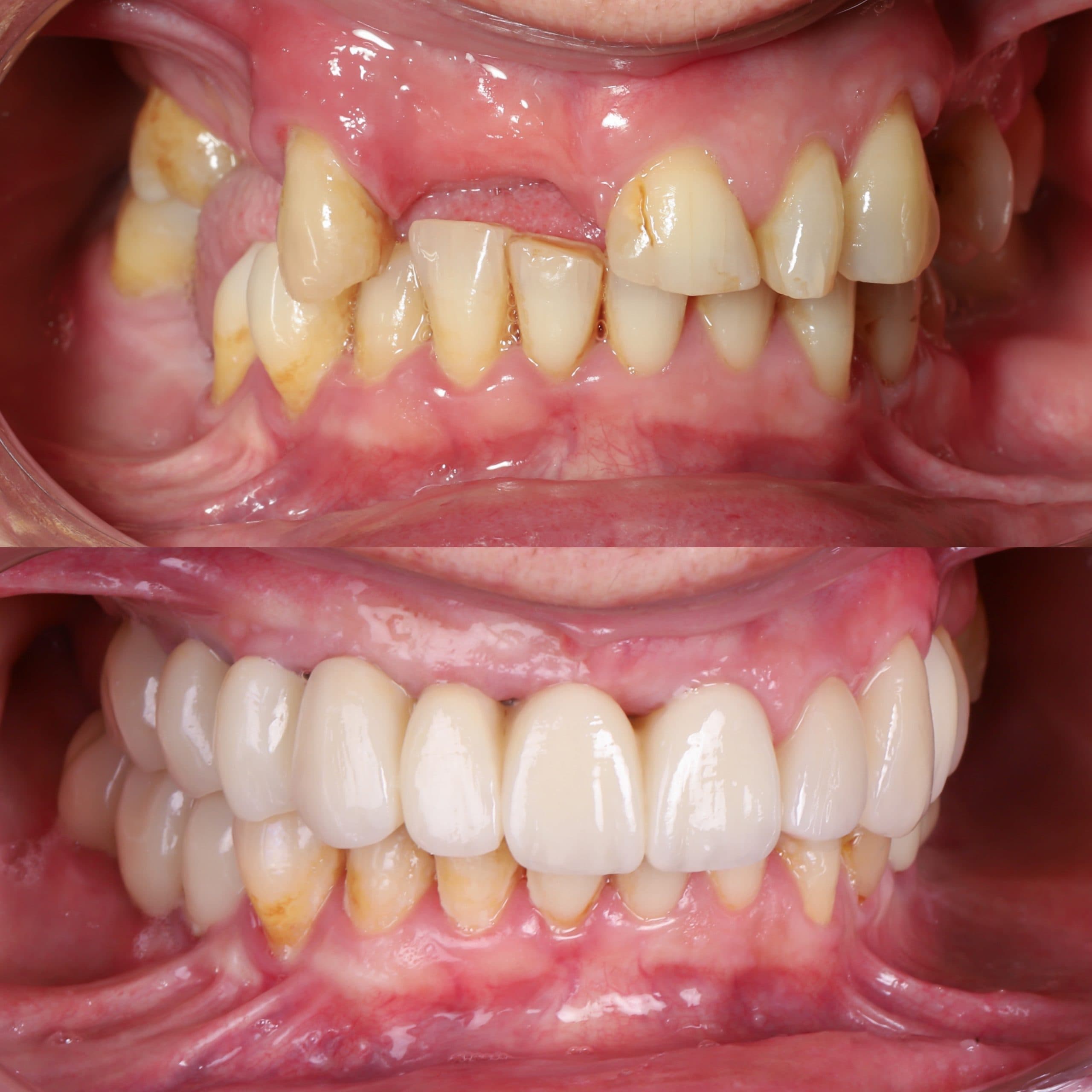 Dental bone graft result
