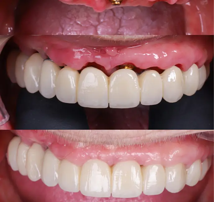 Digital smile design simulation result