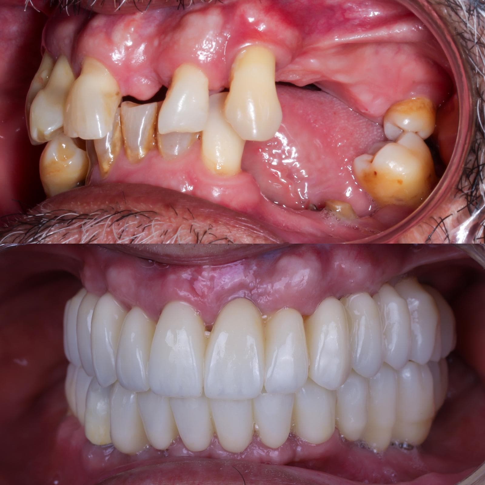Maxillary sinus lift result