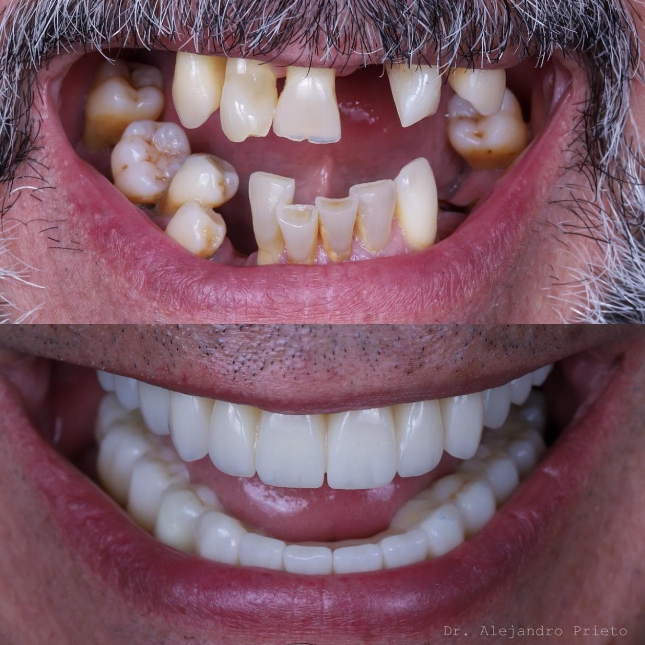 Maxillary sinus lift treatment