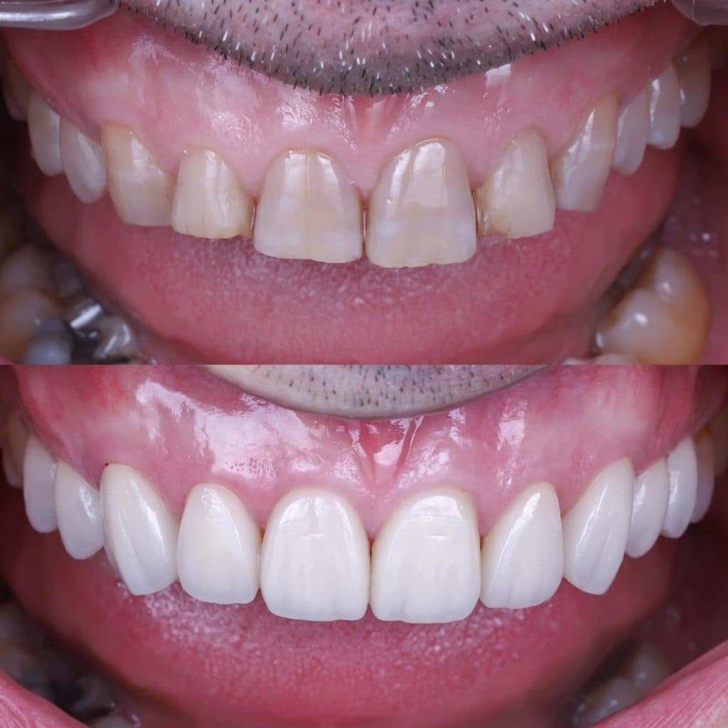 Porcelain veneers before and after
