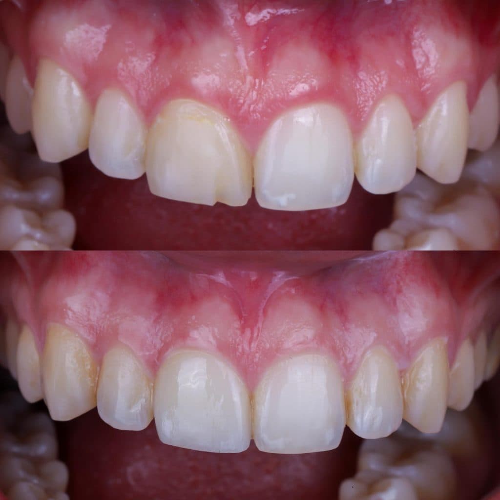 High-aesthetic porcelain veneers