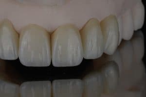 Porcelain veneer treatment result