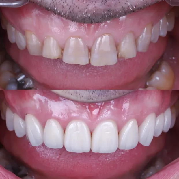 Dental implants — before and after