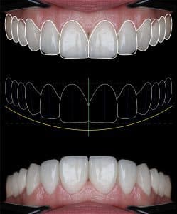 Porcelain veneers — aesthetic smile