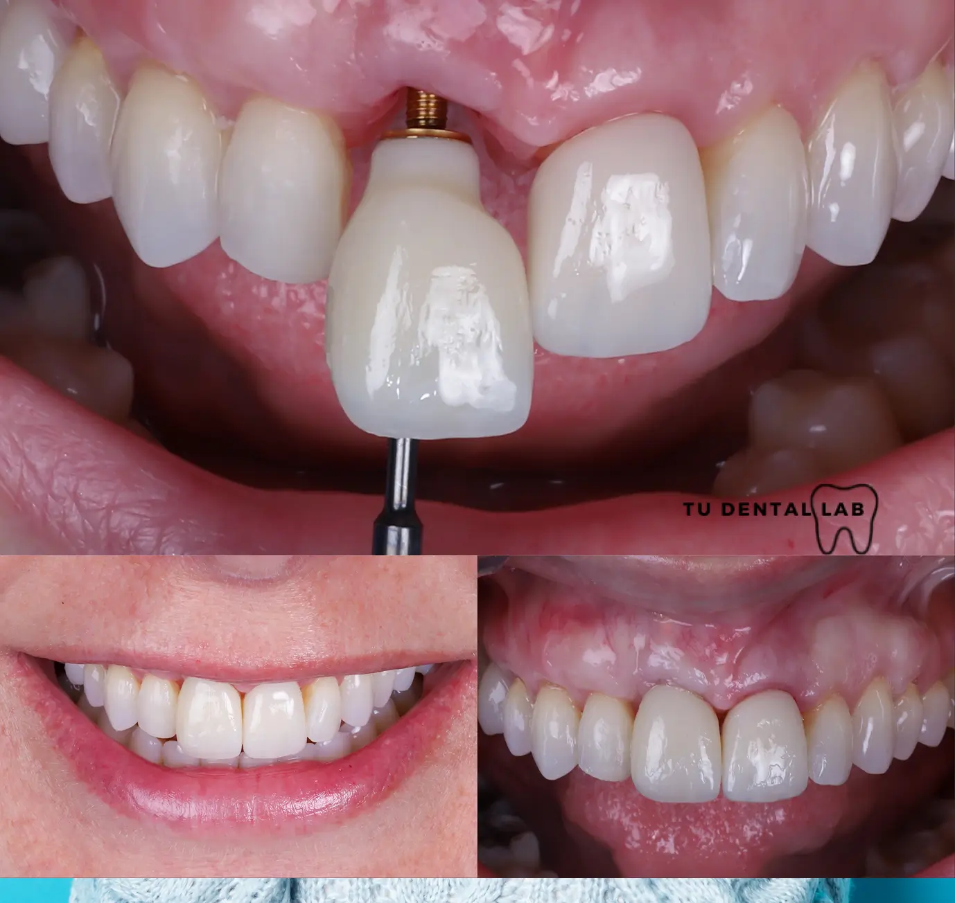 Smile transformation after bone graft and implants