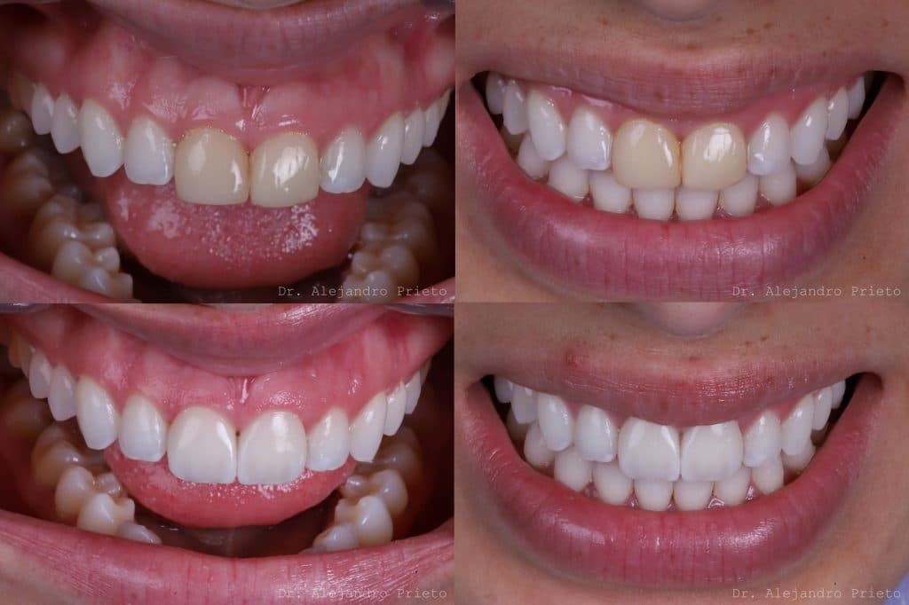 Porcelain veneer case — aesthetic smile