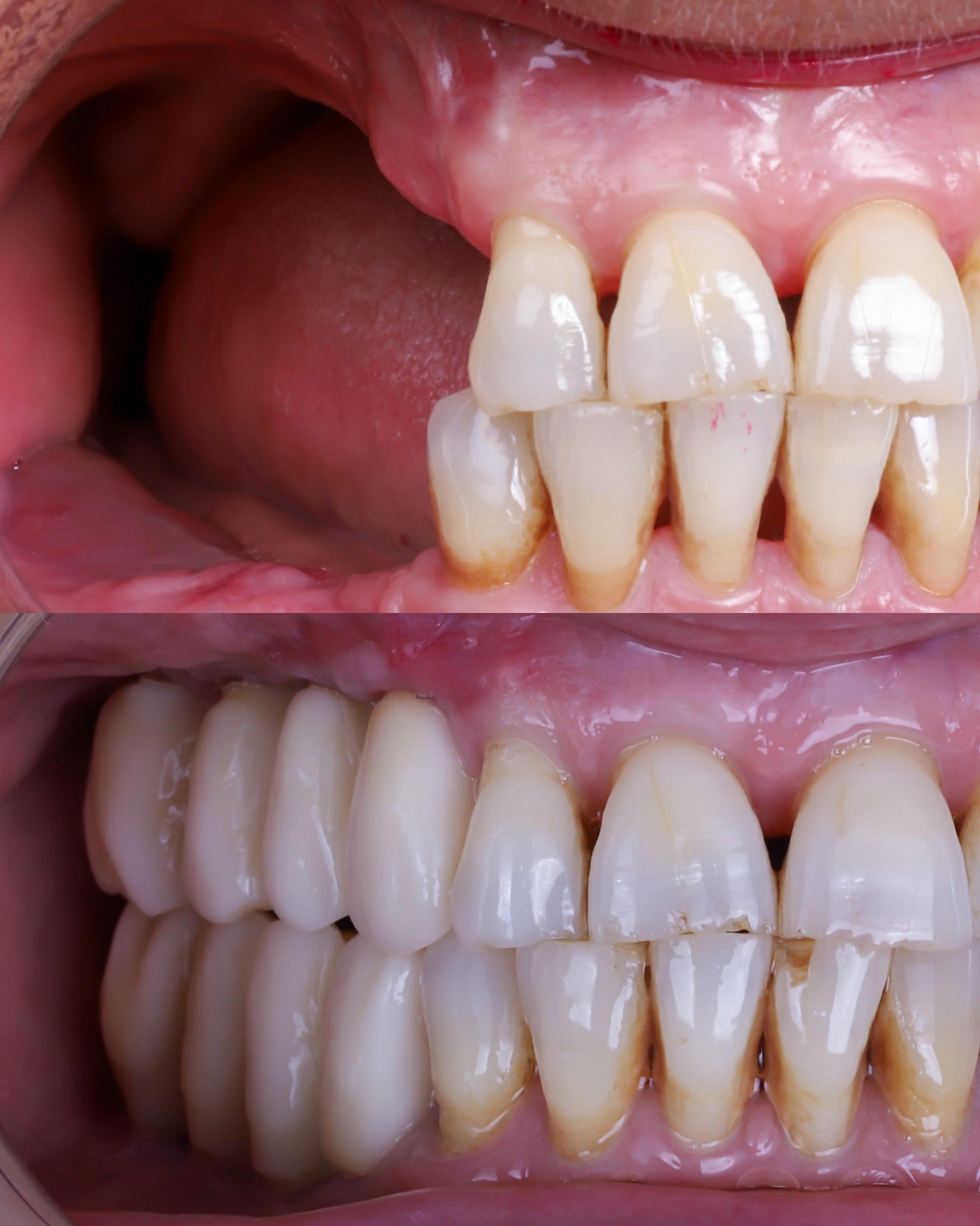 Dental bone graft treatment